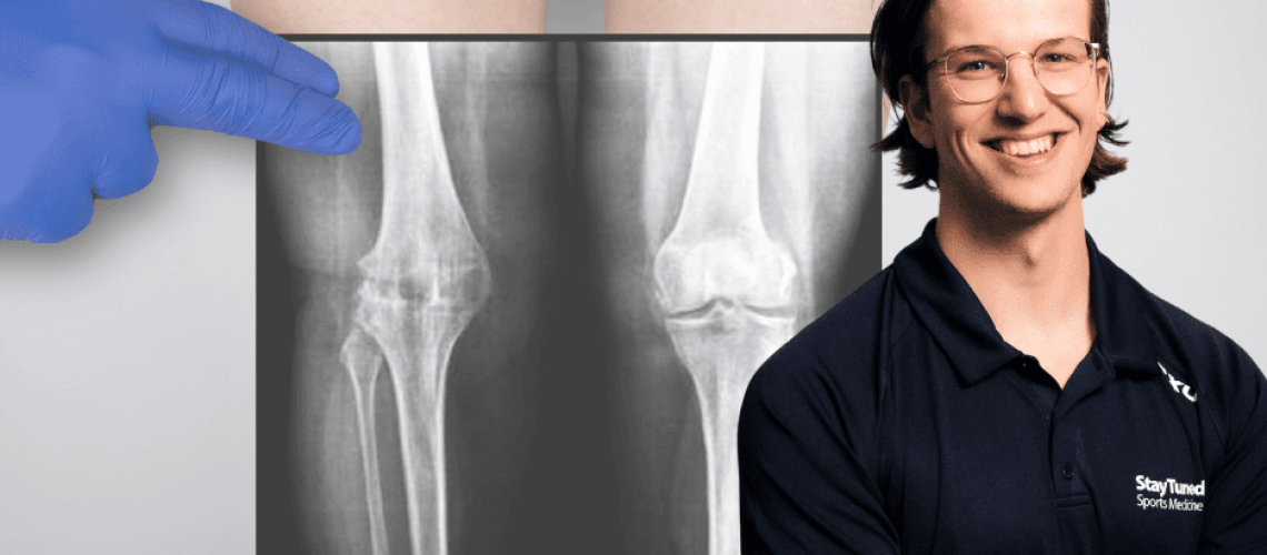osteoporosis dan osteoporosis dan